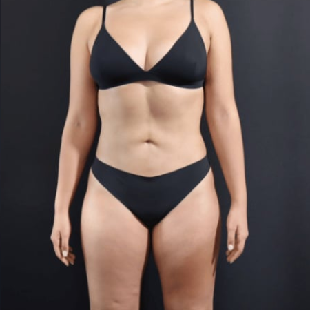 After Body Contouring Procedure