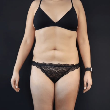 Before Body Contouring Procedure