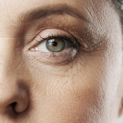 Before Skin Resurfacing Treatment